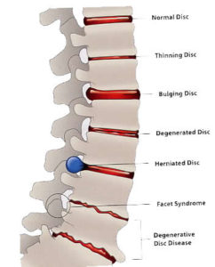 Vax-D Spinal Decompression – Miller-Whitmer Family Chiropractic ...